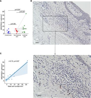 In the skin lesions of patients with mycosis fungoides, the number of MRGPRX2-expressing cells is increased and correlates with mast cell numbers